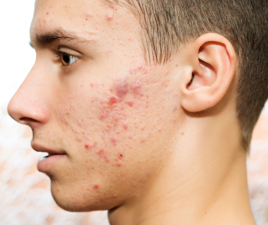 Antifungal Skin Corrective Oil 50ml
