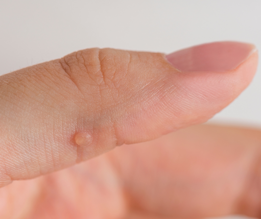 Wart & Verruca Support Oil 30ml