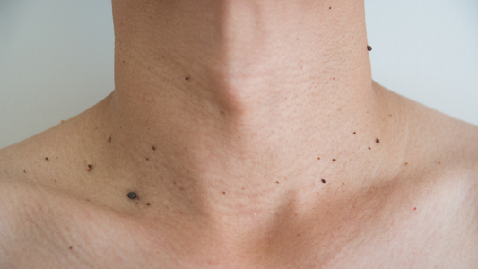 Skin Tag Support