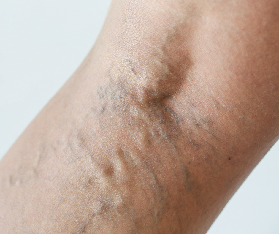 Varicose Veins