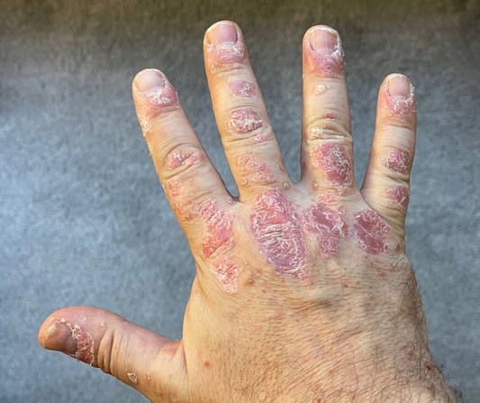 Antifungal Skin Corrective Oil 50ml