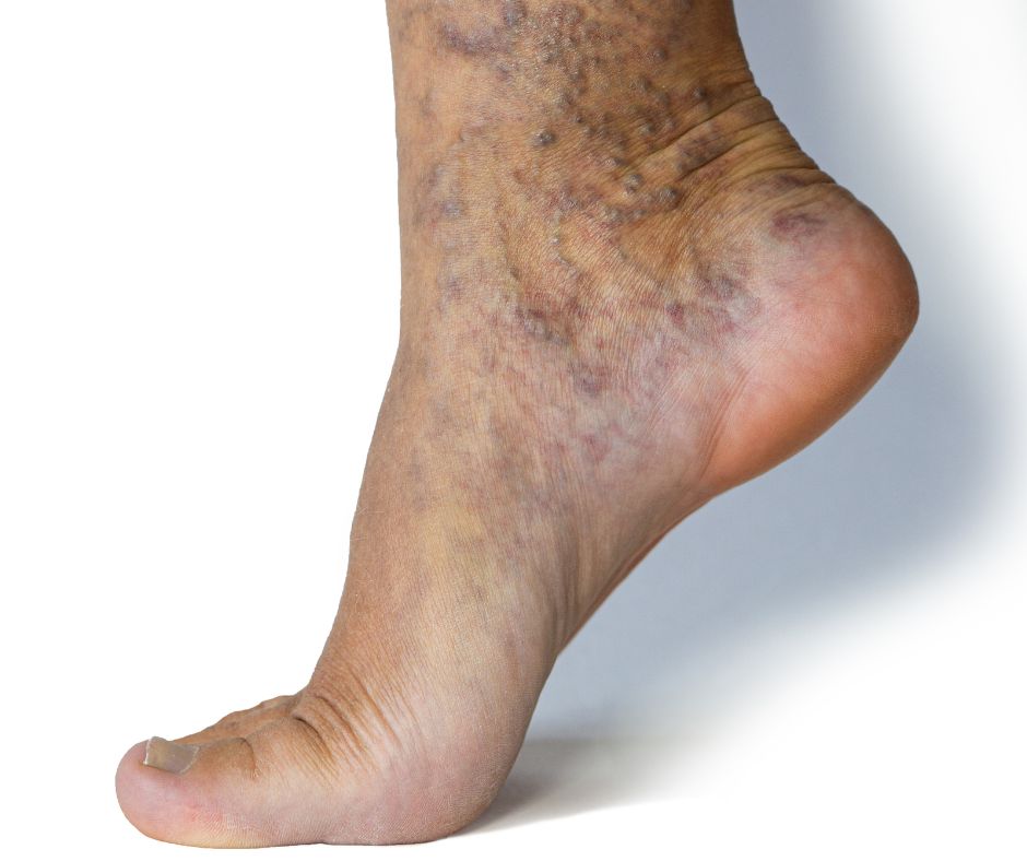 Varicose Vein Support Spray 100ml - June Product of the Month