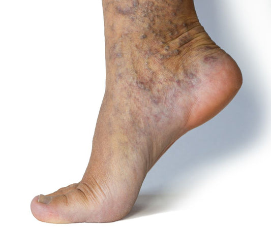 Varicose Vein Support Spray 100ml