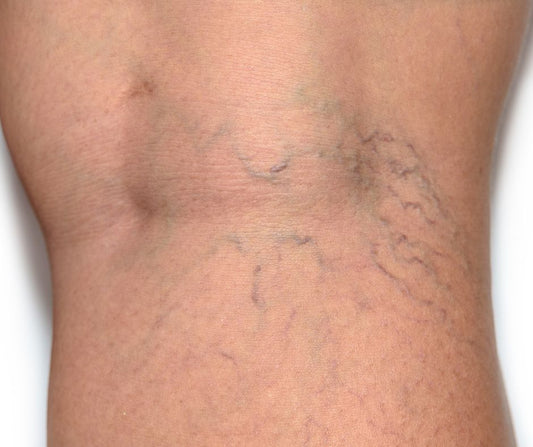 Varicose Vein Support Spray 100ml