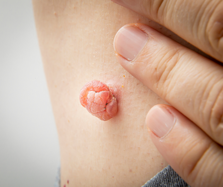 TagZapper - Skin Tag Support