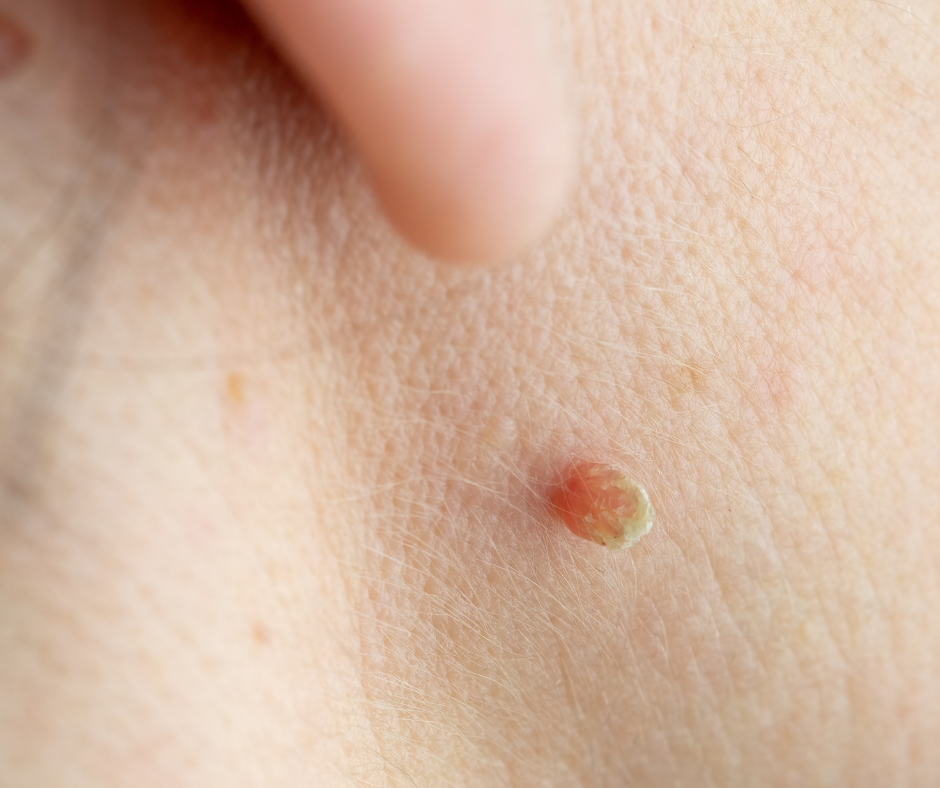 TagZapper - Skin Tag Support